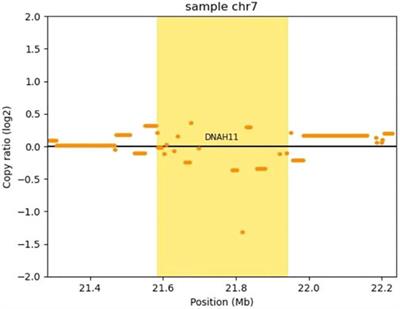 A Novel Compound Heterozygous Mutation in the DNAH11 Gene Found in Neonatal Twins With Primary Ciliary Dyskinesis